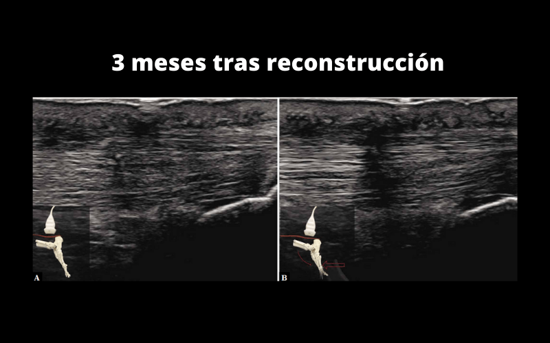 Tendón Aquiles Ecografía - Valoración Dinámica | Tempo Formación